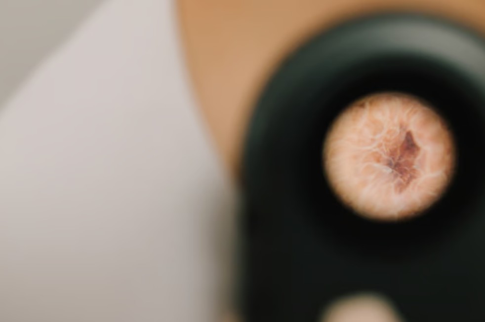 Nei cutanei sulla pelle monitorati per la prevenzione del melanoma e dei tumori della pelle