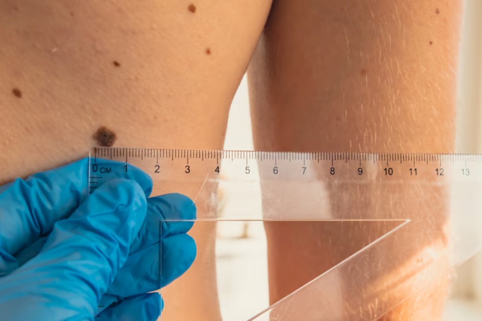 Segni di rischio nei nei secondo la regola ABCDE per individuare precocemente il melanoma