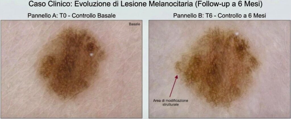 Evoluzione di una lesione melanocitica nel tempo con cambiamenti di forma, colore e dimensione