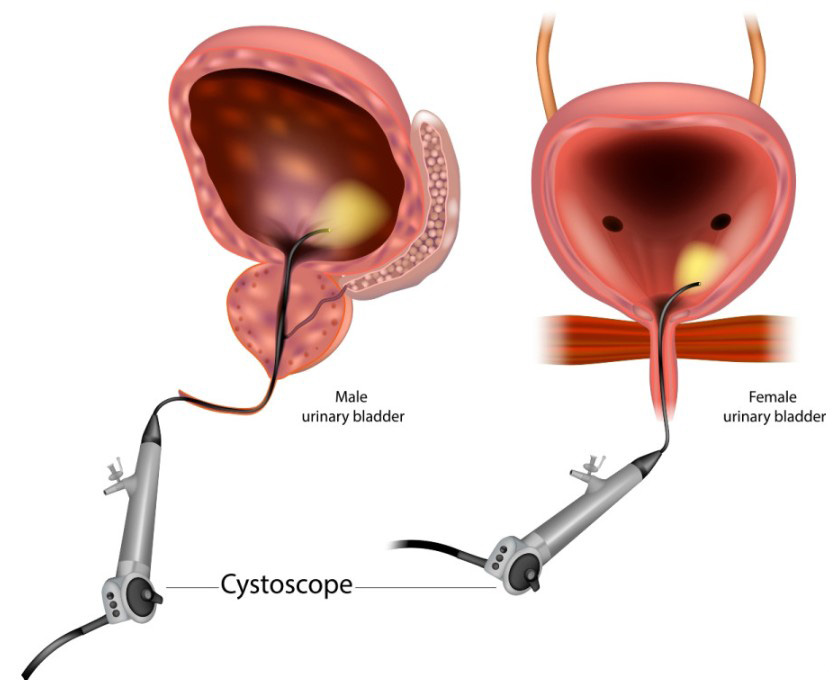 diagramma di cistoscopia uomo e donna con inserimento del cistoscopio nell’uretra per esame della vescica e delle vie urinarie 
