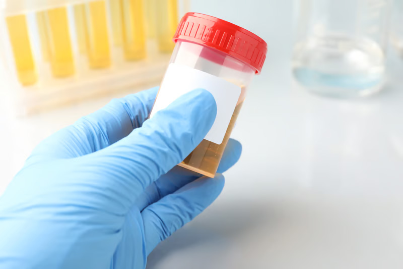 Esame delle urine per valutare presenza di sangue nelle urine e cause dell’ematuria 