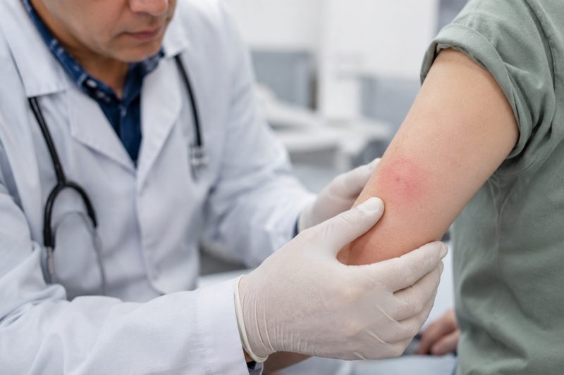 Valutazione medica di una lesione cutanea dopo un possibile morso di ragno.
