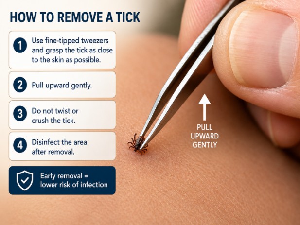 How to remove a tick from the skin using correctly positioned tweezers.