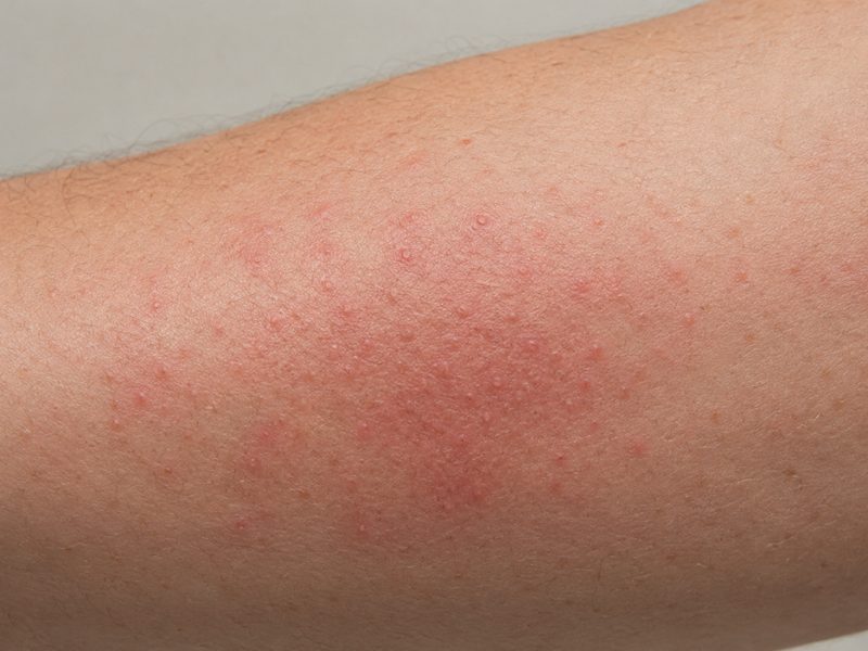 Irritazione della pelle dopo il contatto con i peli urticanti della processionaria.